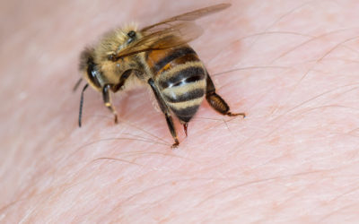 BEE-ware: Allergy to Bee Stings